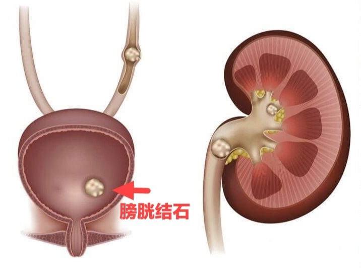 【院讯】我院成功为78岁高龄老人实施微创膀胱结石手术，术后恢复良好